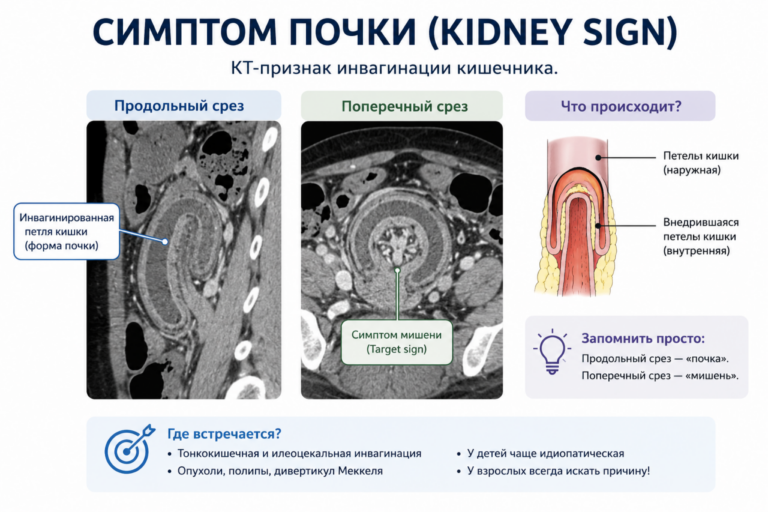 🔍 Рентгенологический симптом: «Симптом почки» (Kidney Sign)